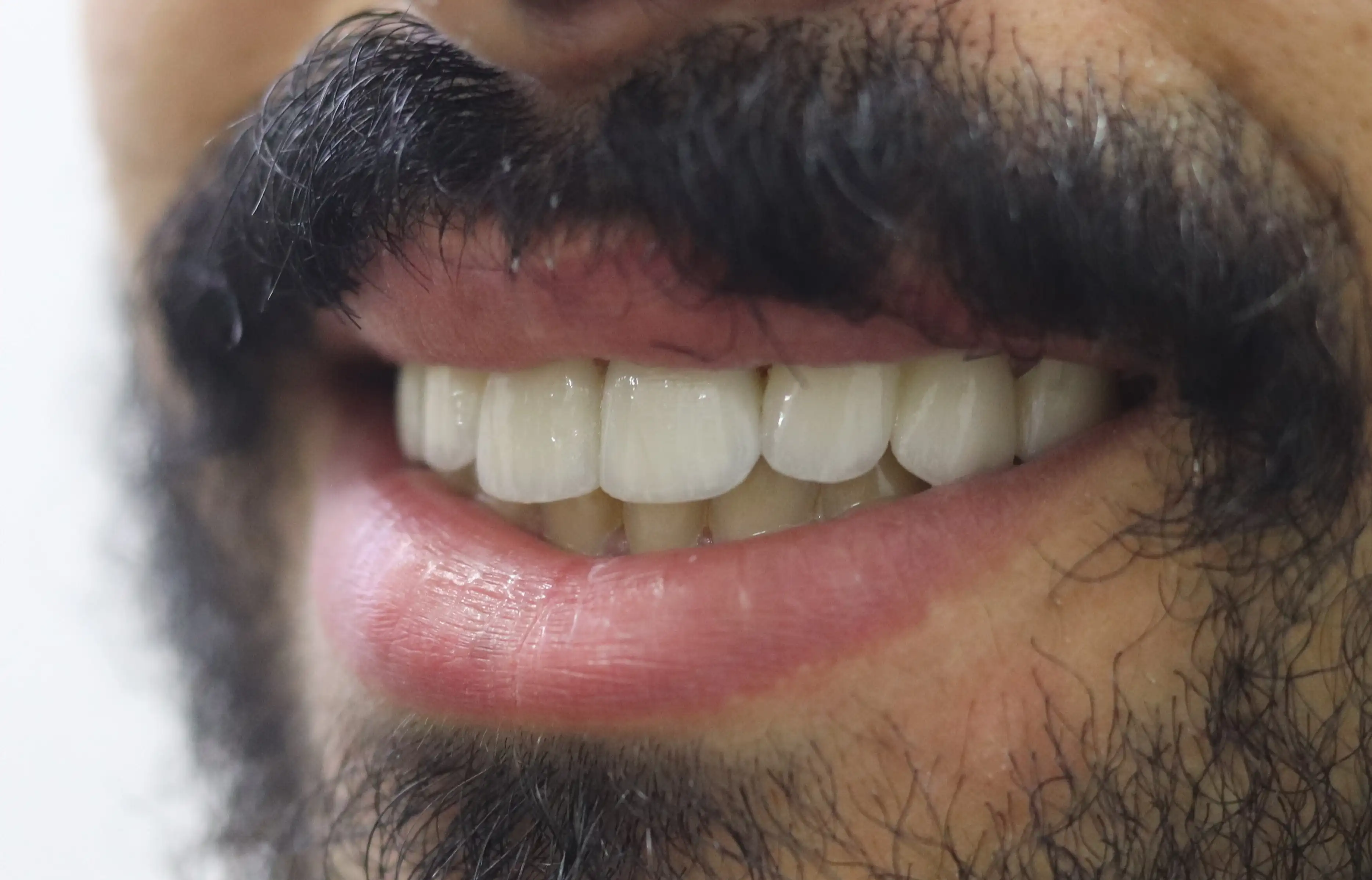 فينيرز وتجميل الأسنان - بعد