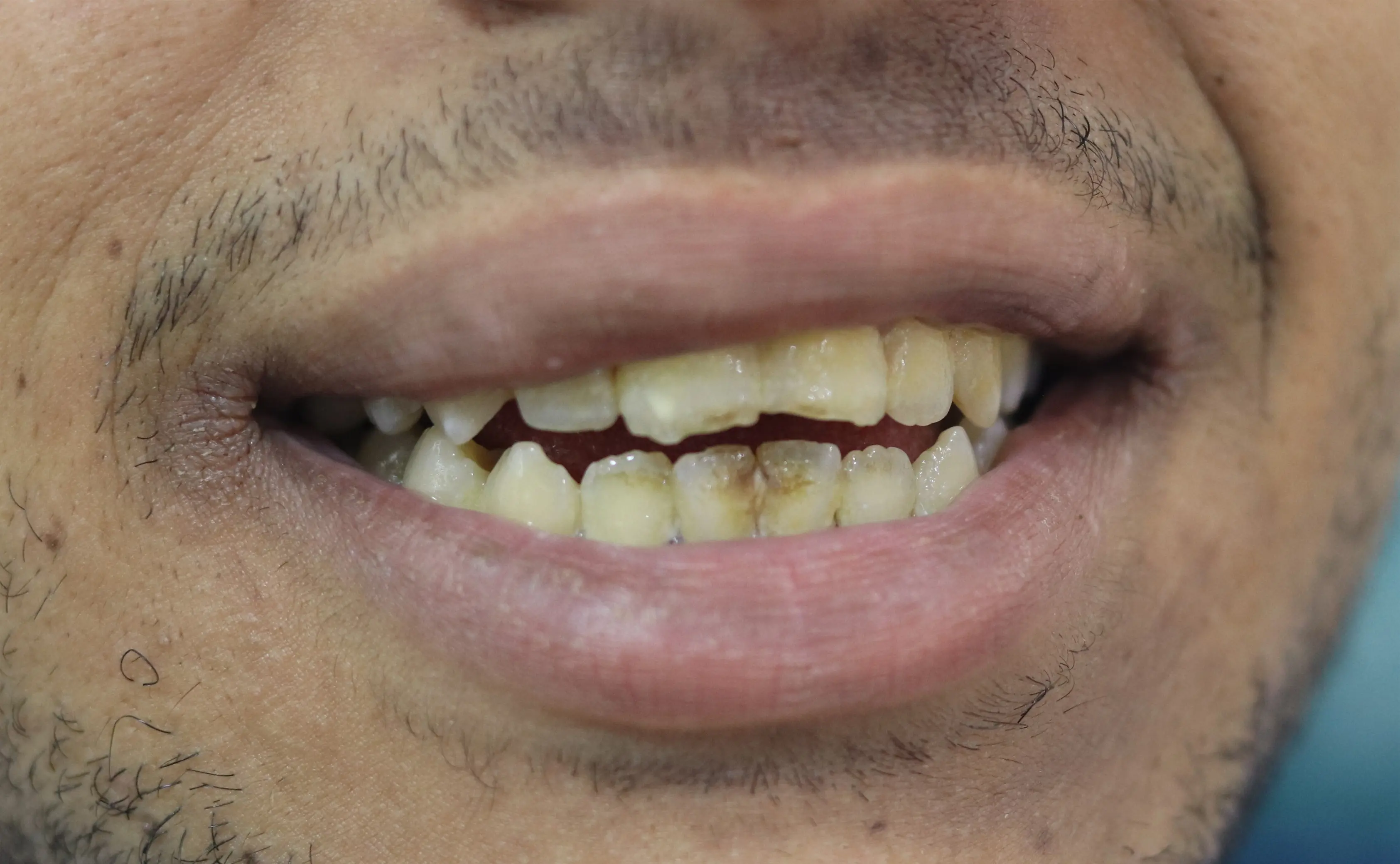 تنظيف الجير وتلميع الأسنان - قبل