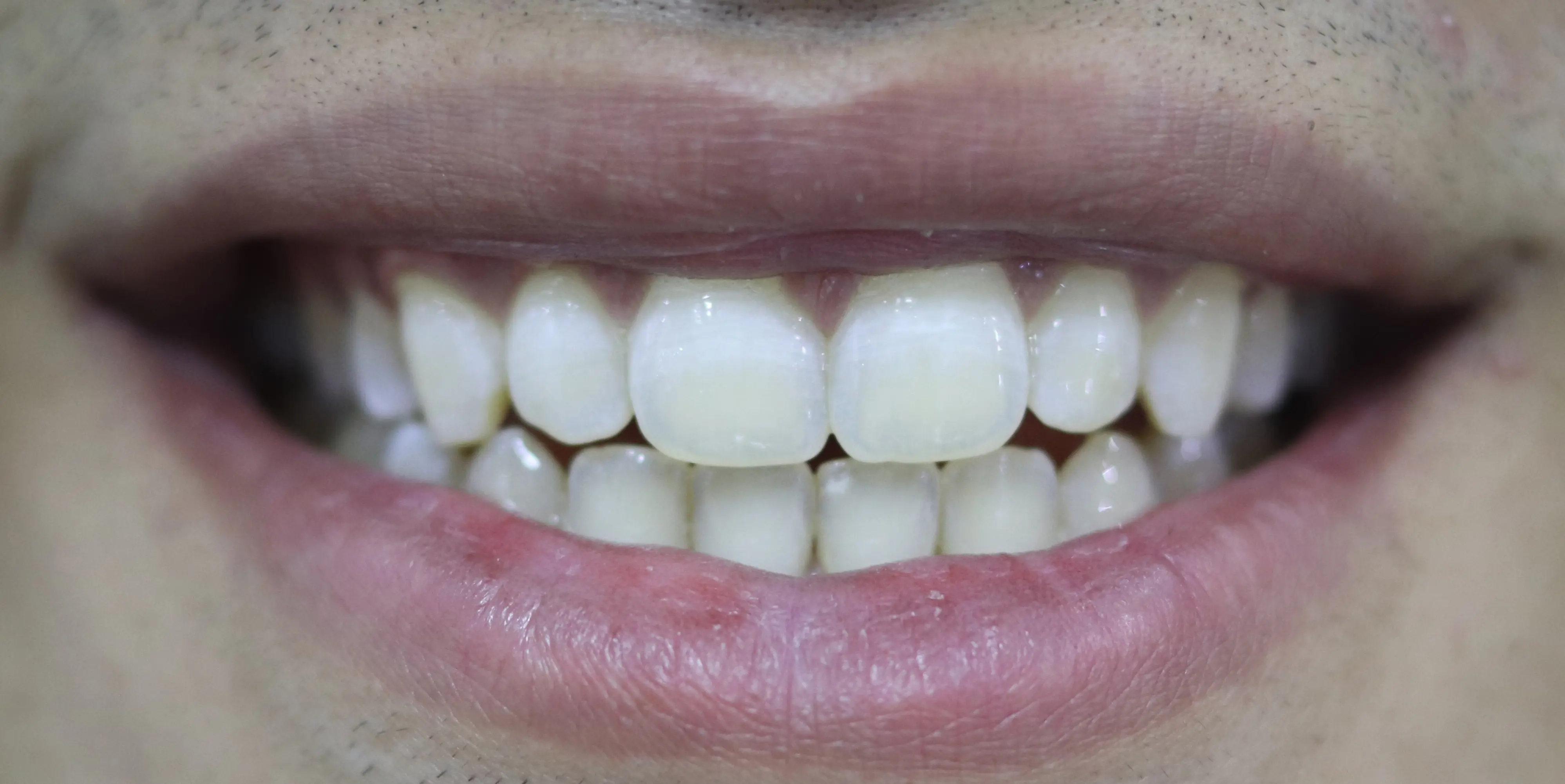 تبييض الأسنان - بعد